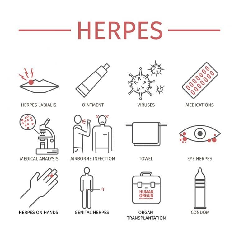 Herpes (Herpes Simplex)