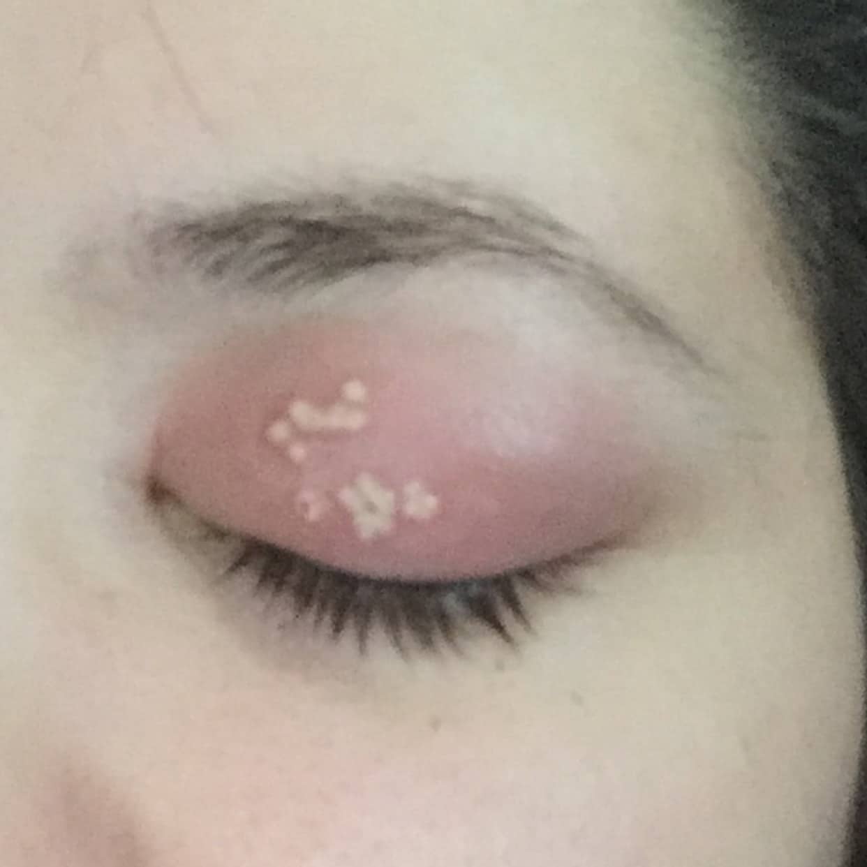 Shingles On The Eyelid Pictures