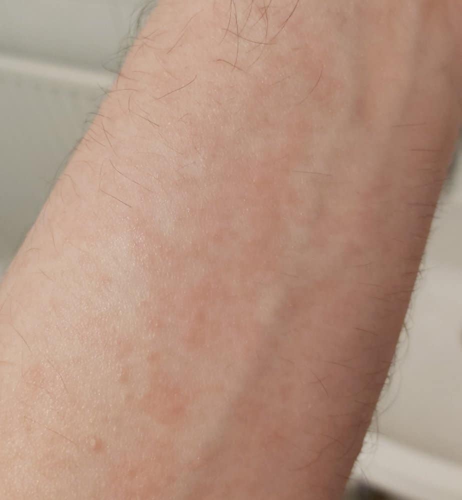 What Can I Put On Shingles To Stop The Itching